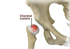 Chondral Lesions or Injuries