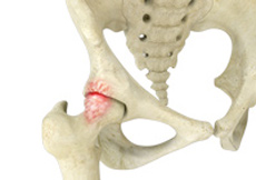 Femoroacetabular Impingement