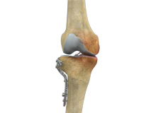 High Tibial Osteotomy