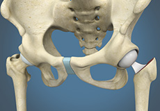 Hip Hemiarthroplasty