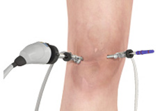 Knee Arthroscopy