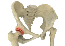 Osteoarthritis of the Hip