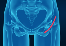 Outpatient Hip Replacement